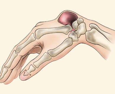 Ganglion Cyst diagram