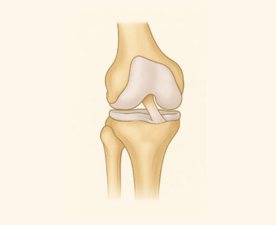 ACL reconstruction graphic
