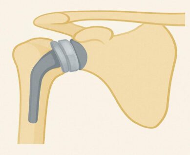 Shoulder Replacement Surgery