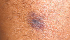 Skin Cancer