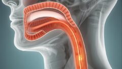 Barretts Oesophagus